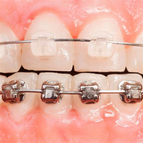 Braces Inside Teeth Vs Outside • Orthodontists In South Miami