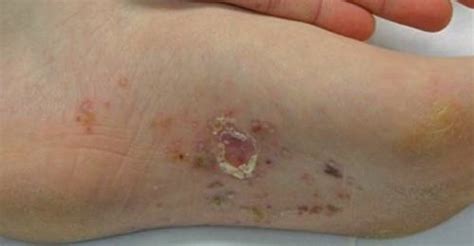 Dyshidrotic Eczema Blisters Itchy Bumps On Hands Feet Fingers Etc