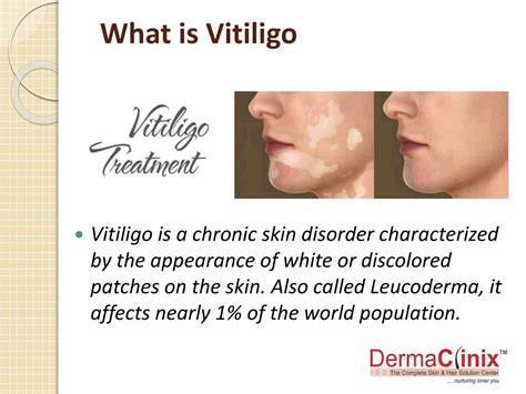 Ppt Best Vitiligo Treatment In South Delhi Powerpoint Presentation