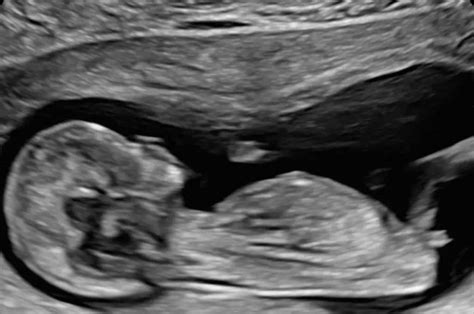 Pregnancy Scans — Galway Ultrasound Specialists