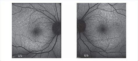 Fundus Photo Of The Right A And Left B Eye Of The Patient With