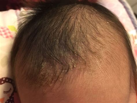 What Is This On My Babys Scalp What Can I Put On It For It To Take Off