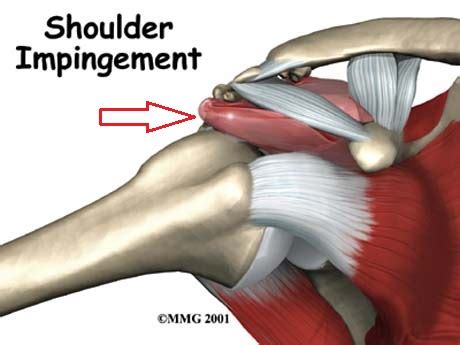 SUBACROMIAL IMPINGEMENT SYNDROME GEORGE D GOUDELIS MD Ph D