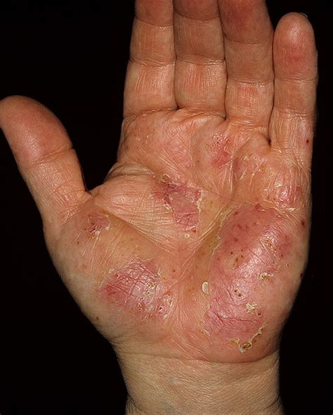 From mildly irritating to intense burning, itchy hands can cause extreme discomfort and even affect a specific type of eczema called 'pompholyx' or 'dyshidriotic' can affect the palms and outsides of the fingers. Dyshidrosis on Hands Pictures - 54 Photos & Images ...