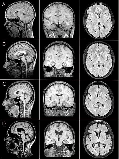 Frontiers Brain Morphometry And Cognitive Performance In Normal Brain Aging Age And Sex