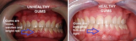 Why You Have Bleeding Gums Vivid Dental