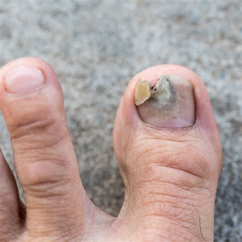 How To Spot And Naturally Treat Toenail Fungus Forces Of Nature Medicine