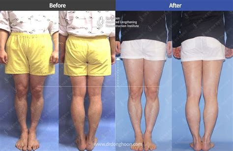 Leg Shortening Surgery Koreaboo