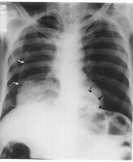 Fig Chest X Ray Showing Right Sided Pneumothorax White Arrows With Sexiz Pix