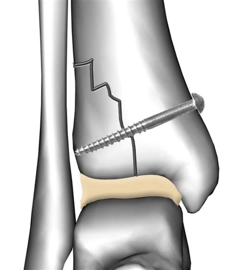 Tibial Fracture With Bone Screw Eccles Health Sciences Library J