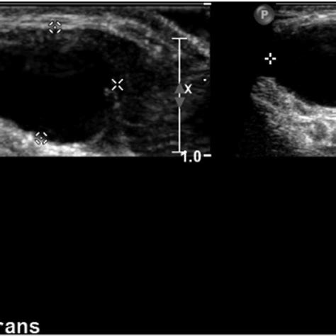 An Ultrasound Scan Of The Anterior Midline Neck Mass A Well Defined 16