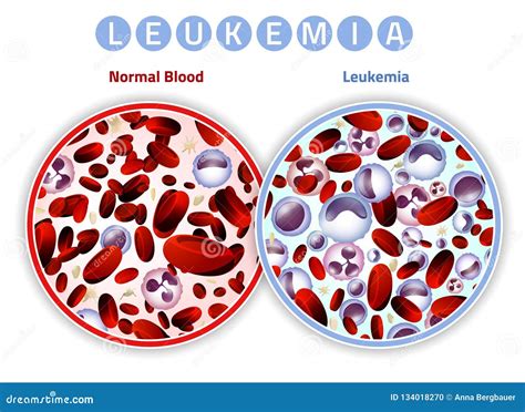 Leukemia Infographic Image Stock Vector Illustration Of Illness