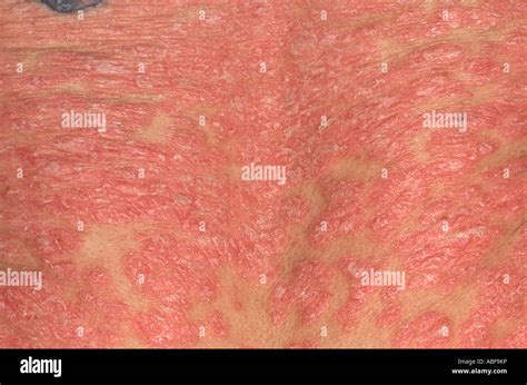 Rash Of Erythrodermic Psoriasis Exfoliative Psoriatic Dermatitis The