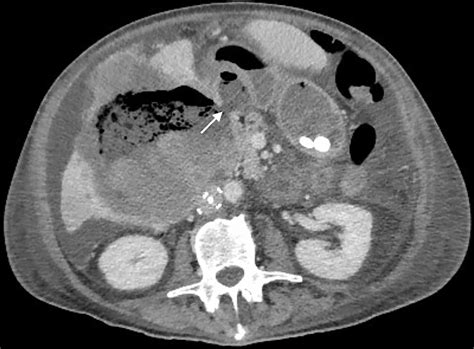 Cureus Metastatic Squamous Cell Carcinoma In The Gallbladder Fossa