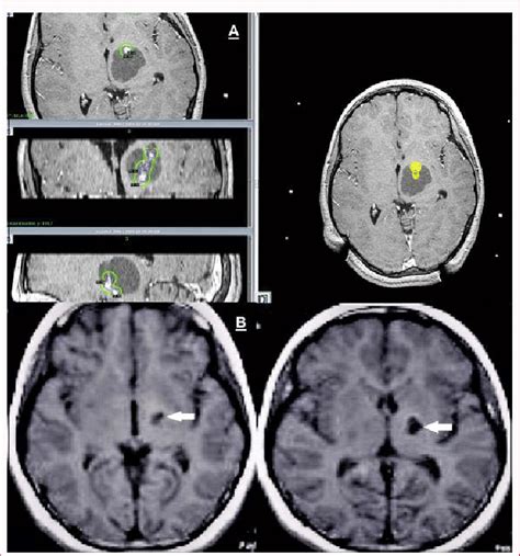 A Stereotactic 3d T1 Weighted Contrast Enhanced Mri Gamma Plan Of