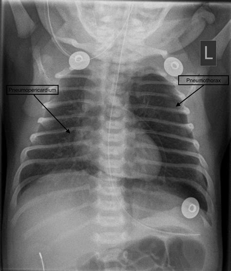 Neonatal Chest X Ray Showing Left Sided Congenital Di Vrogue Co
