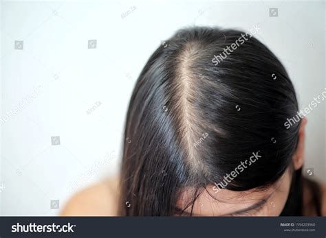 Women Thin Hair There Pulses Hair Stock Photo Edit Now 1554203960