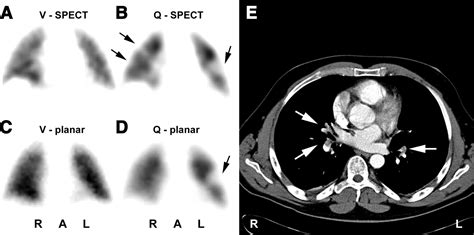Figure 2 Tomographic Imaging In The Diagnosis Of Pulmonary Embolism