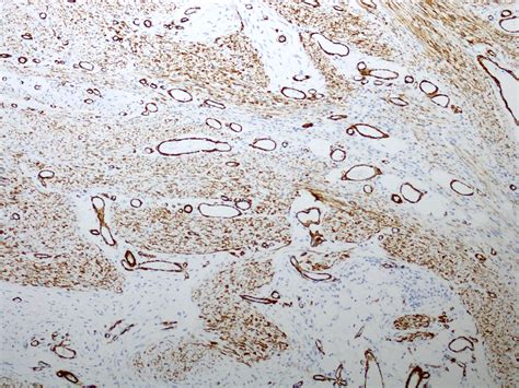 Pathology Outlines Fibrous Hamartoma Of Infancy