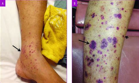 A Initial Presentation Of Recurrent Painful Petechiae And Palpable