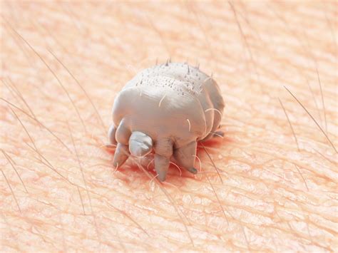 Scabies Needs To Be Taken More Seriously Says Health Researcher