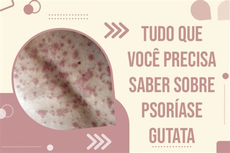 Tudo Que Você Precisa Saber Sobre Psoríase Gutata Psoríase Brasil