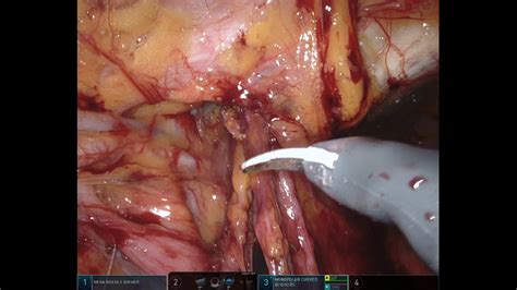 In children, these hernias generally heal without medical treatment by the age of one. Robotic assisted repair of left femoral hernia with bowel ...