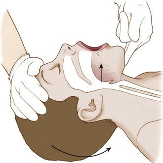 Discover free flashcards, games and test preparation activities designed to help you learn about head tilt chin lift technique and other subjects. Emergency Airway Management | Anesthesia Key