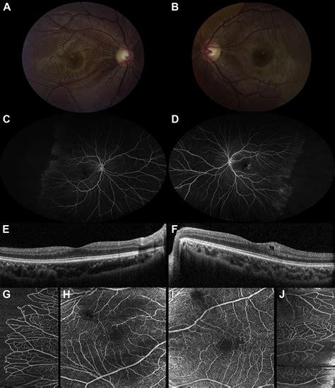 Oct Angiography Of Macular Telangiectasia In Dyskeratosis Congenita