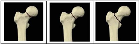 Fractured Neck of Femur - RCEMLearning