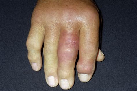 Gout Photograph By Dr P Marazzi Science Photo Library