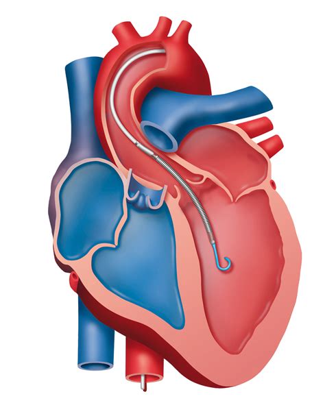 Cardiac Pump