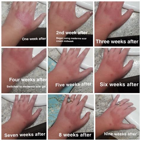 This is one of the mildest forms of skin injuries ans now back home in kansas and almost fully healed, joshua has adjusted well to his ongoing therapy of massages and stretches after his surgeries. A different type of b&a. Nine weeks of healing from 2nd ...