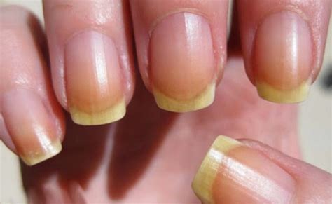Pitted Nails Vitamin Deficiency Awesome Nail