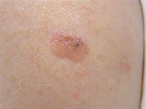 Basal Cell Skin Cancer Moles