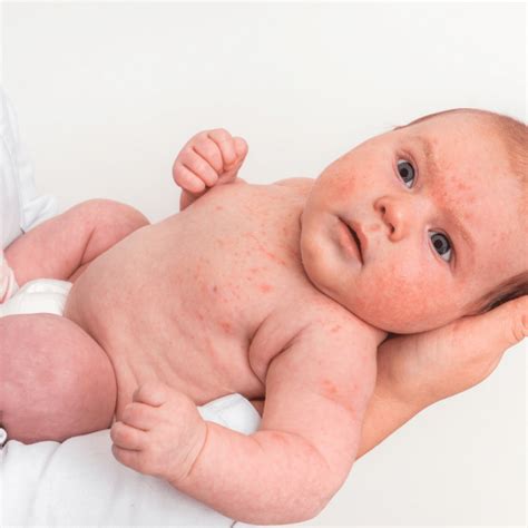 Infants With Eczema Helping Them Sleep Better