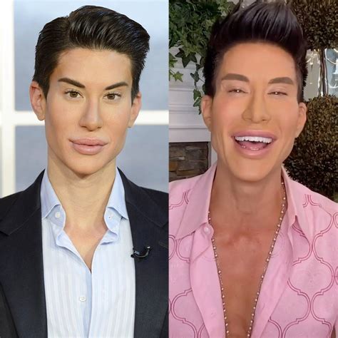 Human Ken Doll Is Back Hear All About His Cosmetic Surgeries In