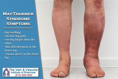 Our Board Certified Vascular Surgeons Treat May Thurner Syndrome Using