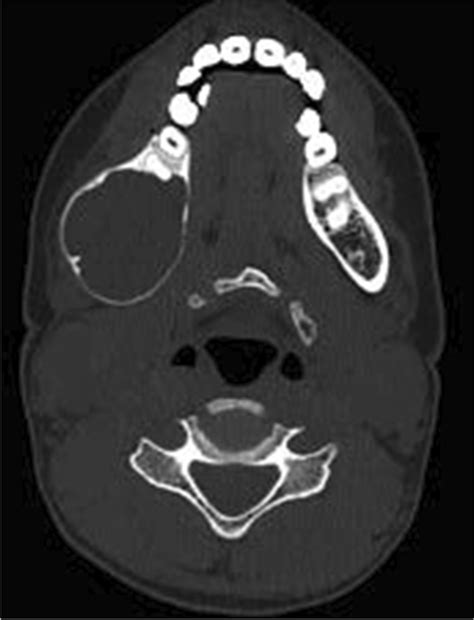 Axial Cut Ct Image Showing Ma With Intact Buccal And Lingual Cortex