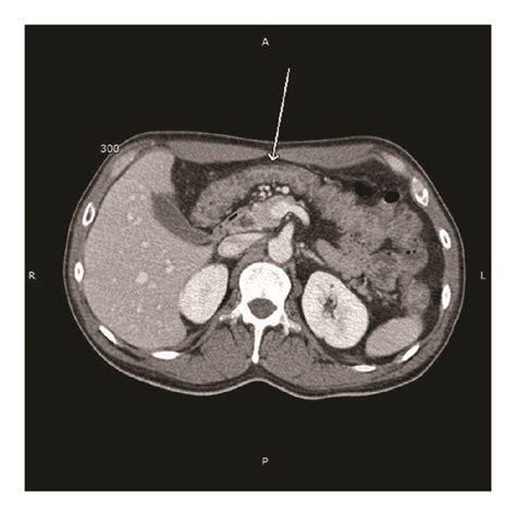 Abdominal Computed Tomography Showing Diffuse Circumferential