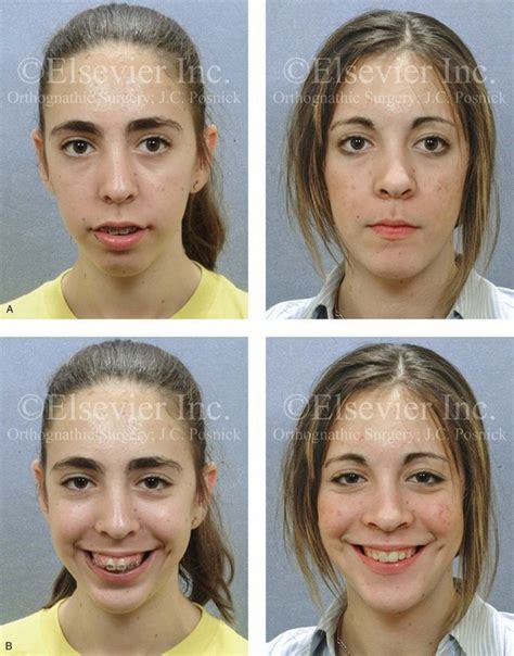 Malocclusion After Orthodontics And Orthognathic Surgery Prevention