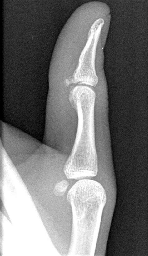 X Ray Of A Thumb Creative Commons Photo By Akeg