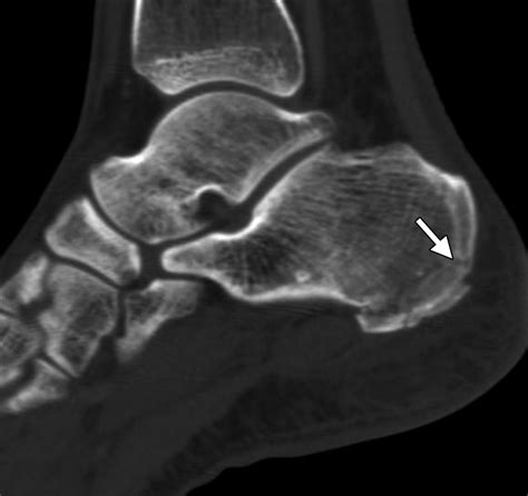Multidetector Ct Evaluation Of Calcaneal Fractures Radiographics