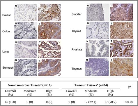 Gal 3BP Expression In Human Tumor Tissues A Gal 3BP Protein