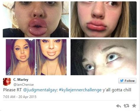 Too Far People Bruise Make Their Lips Swell To Achieve Kylie Jenner
