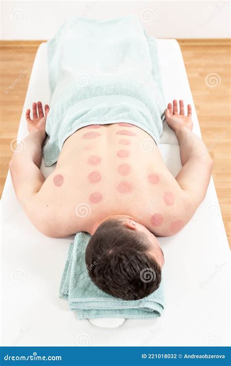 Young Man Relaxing After Vacuum Cupping Therapy High Angle View Of A Back With Skin Bruising