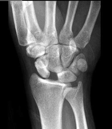 Scapholunate Interval Radiology Reference Article Radiopaedia Org