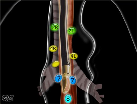 The Radiology Assistant Mediastinum Lymph Node Map