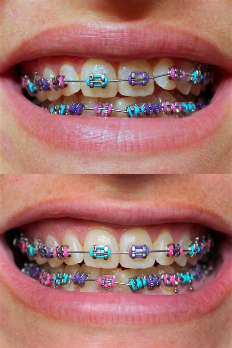Sky Blue Braces Colors This Will Help Website Stills Gallery