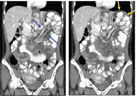 Abdominal Computed Tomography With Oral And Intravenous Contrast